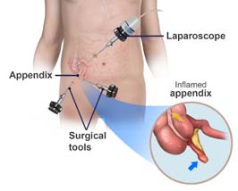 Laparoscopic Adhesiolysis