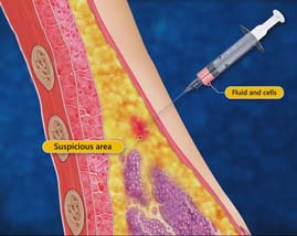 Aspiration Cytology of Lump or Cyst