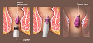 Banding of Haemorrhoids