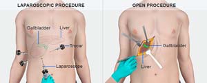 Cholecystectomy