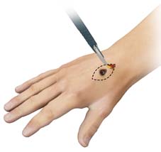 excision-of-skin-lesions.jpg