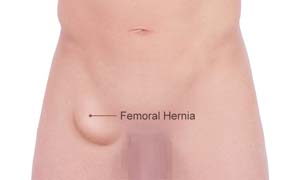 Femoral Hernia