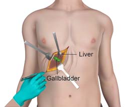 Gallbladder Surgery