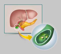 Gall Stones