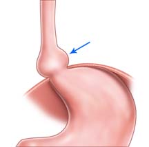 Hiatus Hernia