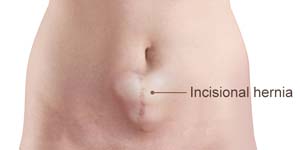 Incisional Hernia