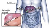 Laparoscopic Cholecystectomy for Gallstones