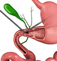 Laparoscopic Repair of Duodenal Perforation