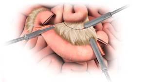 Laparoscopic Small Bowel Resection 