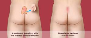 Pilonidal Sinus