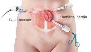 Umbilical and Paraumbilical Hernia Repair Colchester, Essex