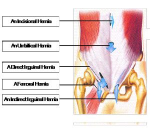 Hernia