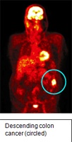 Positron Emmission Tomography