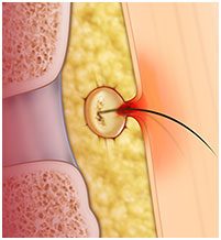 Endoscopic Pilonidal Sinus Treatment