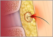 Endoscopic Pilonidal Sinus Treatment